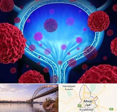 دکتر سرطان مثانه در اهواز