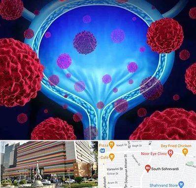دکتر سرطان مثانه در سهروردی 