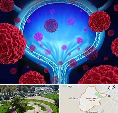 دکتر سرطان مثانه در مهرشهر کرج 