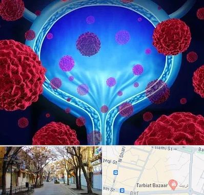 دکتر سرطان مثانه در تربیت تبریز