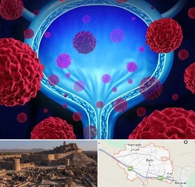 دکتر سرطان مثانه در بم
