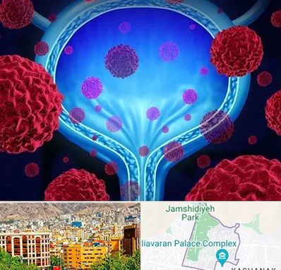 دکتر سرطان مثانه در نیاوران 