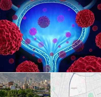 دکتر سرطان مثانه در جمشیدیه