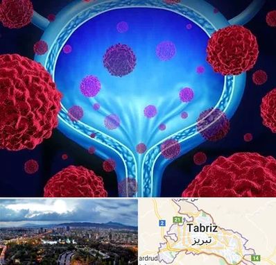 دکتر سرطان مثانه در تبریز