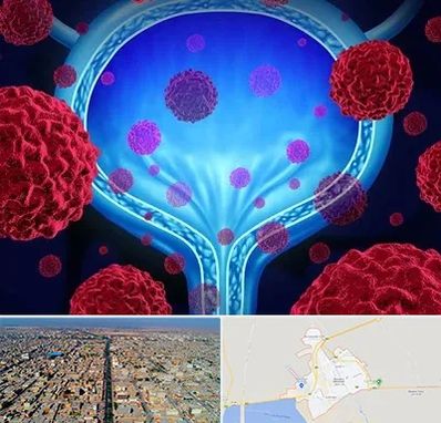 دکتر سرطان مثانه در بندر ماهشهر