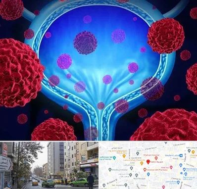 دکتر سرطان مثانه در فاطمی 