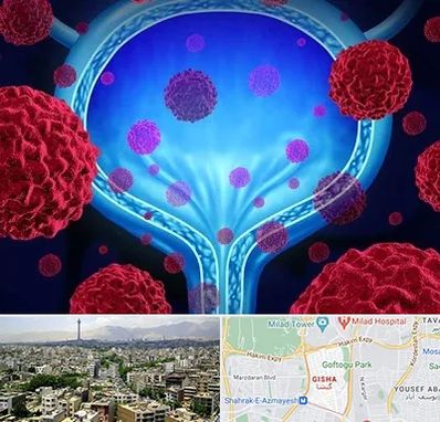 دکتر سرطان مثانه در گیشا 