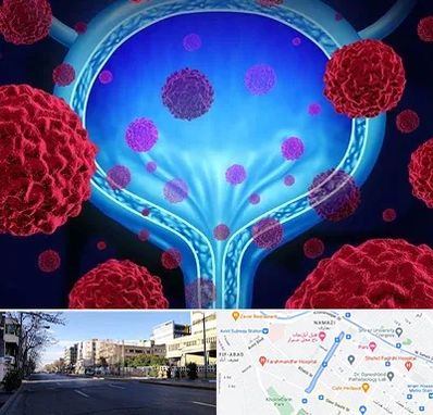 دکتر سرطان مثانه در خیابان ملاصدرا شیراز 