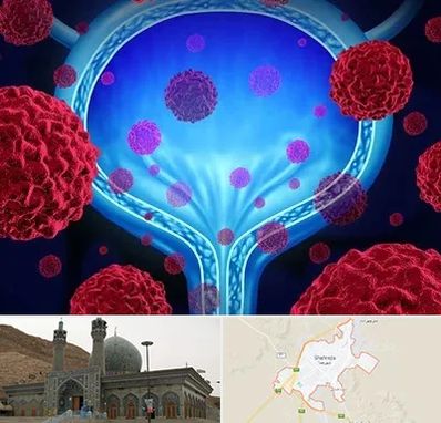 دکتر سرطان مثانه در شهرضا