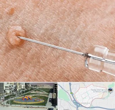 لیزر زگیل تناسلی در مرزداران تبریز