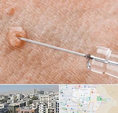 لیزر زگیل تناسلی در منطقه 14 تهران 