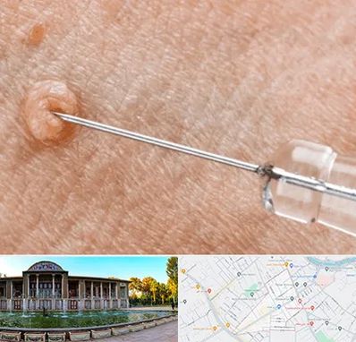 لیزر زگیل تناسلی در عفیف آباد شیراز 