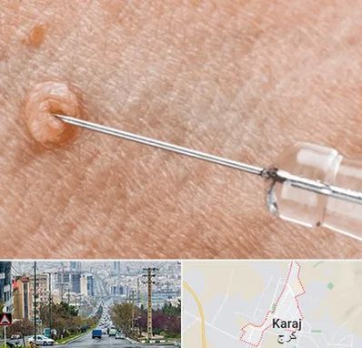 لیزر زگیل تناسلی در گوهردشت کرج 