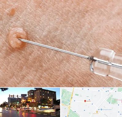 لیزر زگیل تناسلی در بلوار سجاد مشهد 