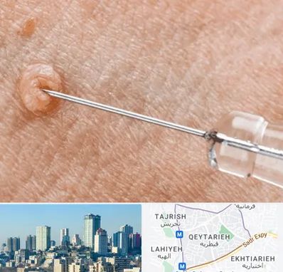 لیزر زگیل تناسلی در قیطریه 