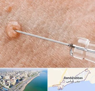 لیزر زگیل تناسلی در بندرعباس