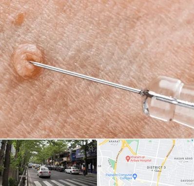 لیزر زگیل تناسلی در ظفر 