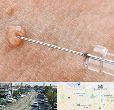 لیزر زگیل تناسلی در جنوب تهران 