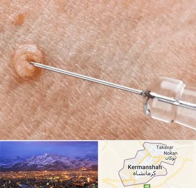 لیزر زگیل تناسلی در کرمانشاه