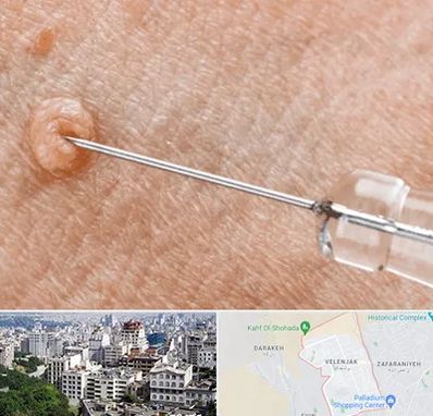 لیزر زگیل تناسلی در ولنجک 