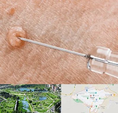 لیزر زگیل تناسلی در بجنورد