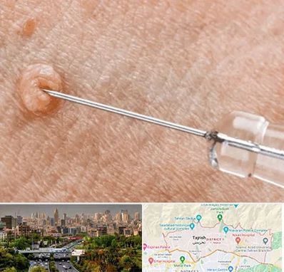 لیزر زگیل تناسلی در منطقه 1 تهران 