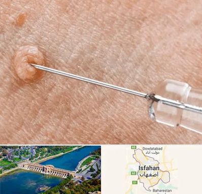 لیزر زگیل تناسلی در اصفهان