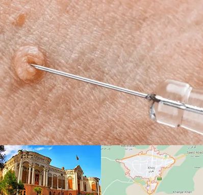 لیزر زگیل تناسلی در خوی