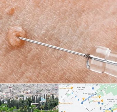 لیزر زگیل تناسلی در محلاتی شیراز 