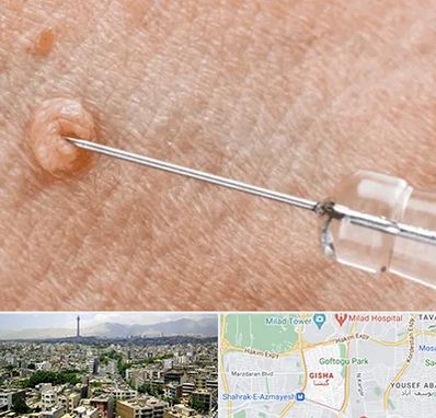 لیزر زگیل تناسلی در گیشا 