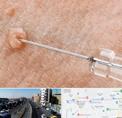 لیزر زگیل تناسلی در پیروزی 