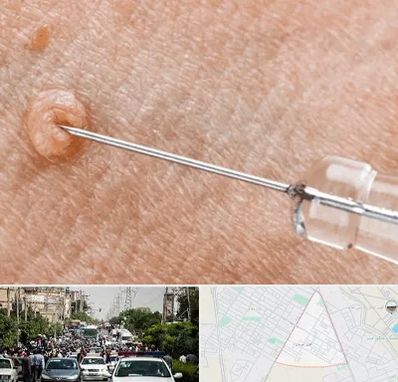 لیزر زگیل تناسلی در سیدی مشهد