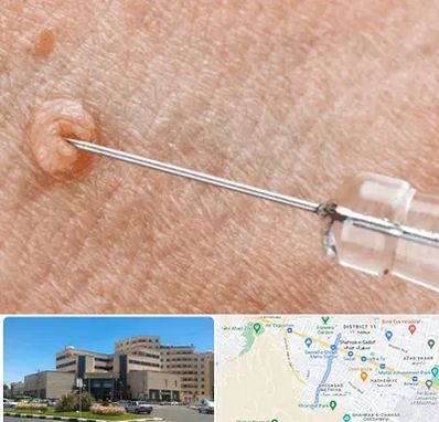 لیزر زگیل تناسلی در صیاد شیرازی مشهد 