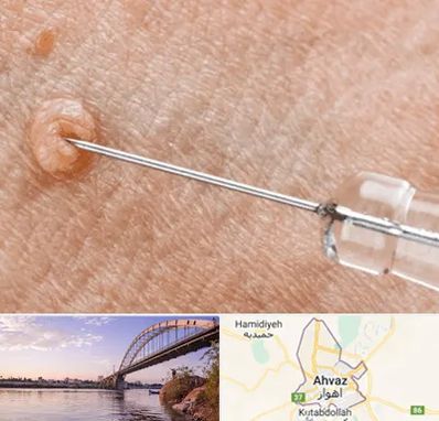 لیزر زگیل تناسلی در اهواز