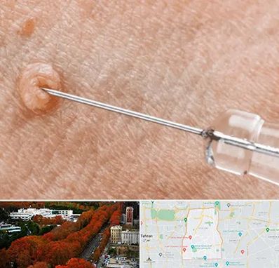 لیزر زگیل تناسلی در منطقه 6 تهران 