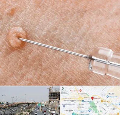 لیزر زگیل تناسلی در بلوار توس مشهد 