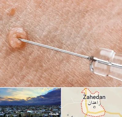 لیزر زگیل تناسلی در زاهدان