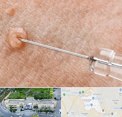 لیزر زگیل تناسلی در نسیم شهر