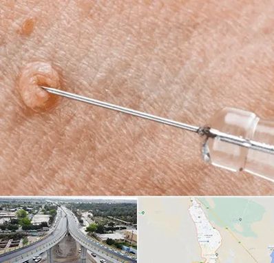 لیزر زگیل تناسلی در اندیمشک