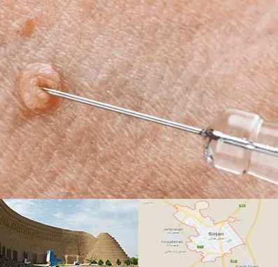 لیزر زگیل تناسلی در سیرجان