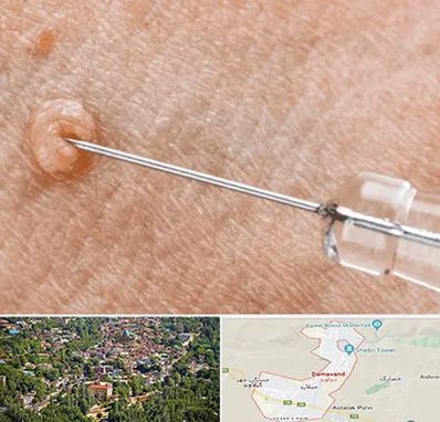 لیزر زگیل تناسلی در دماوند