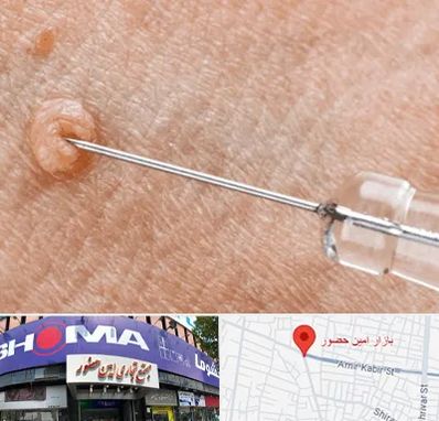 لیزر زگیل تناسلی در امین حضور