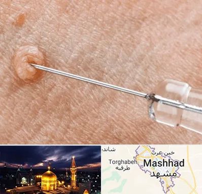 لیزر زگیل تناسلی در مشهد