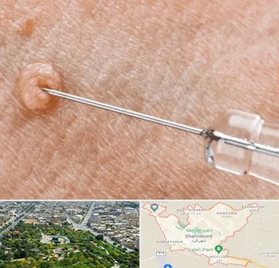 لیزر زگیل تناسلی در شهرکرد