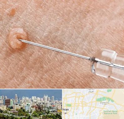 لیزر زگیل تناسلی در شرق تهران 