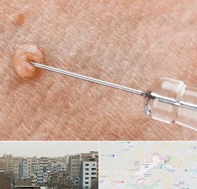 لیزر زگیل تناسلی در محمد شهر کرج 