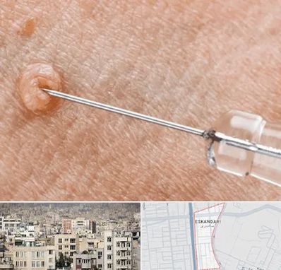 لیزر زگیل تناسلی در اسکندری