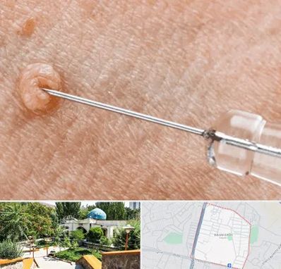 لیزر زگیل تناسلی در باغمیشه تبریز