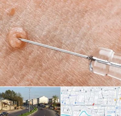 لیزر زگیل تناسلی در ضیابری رشت 