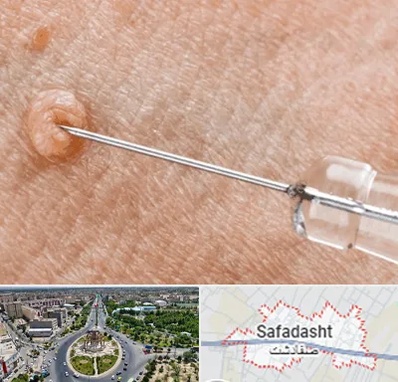 لیزر زگیل تناسلی در صفادشت